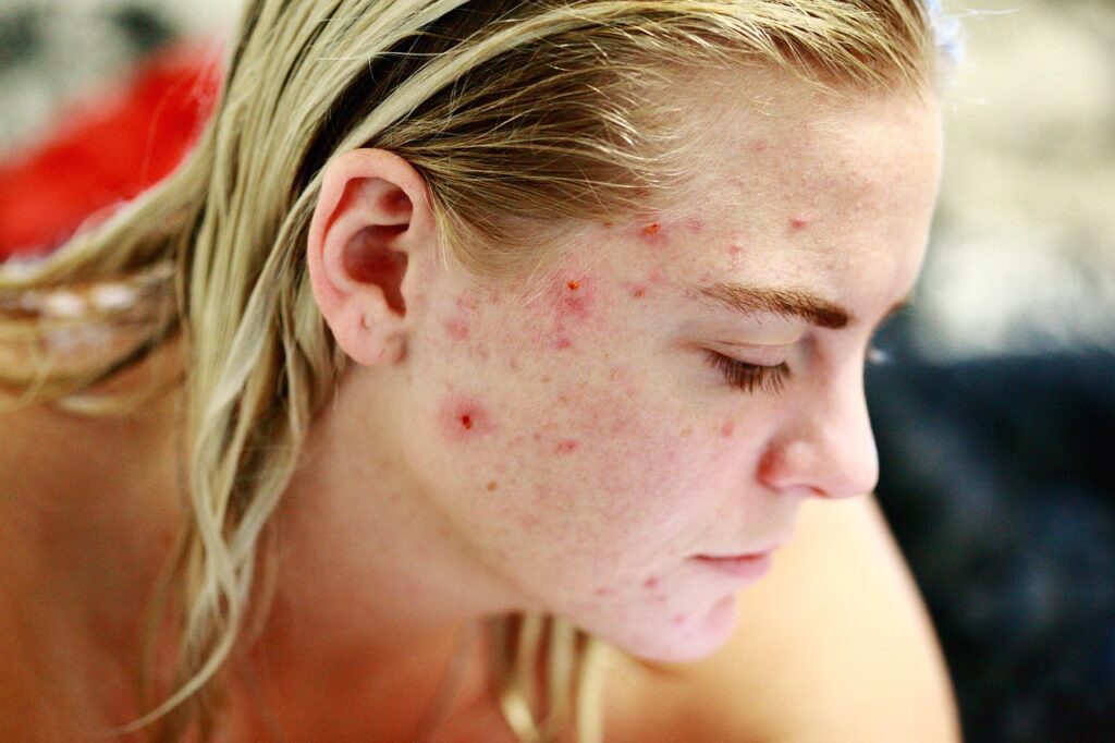 Why Do I Struggle with Acne? struggle, acne, self love, skin, face, portrait, woman, people, reality, girl, female, model, hair, person, human, skincare, character, caucasian, blemishes, pimples, no make up, life, problems, issues, self esteem, brown love, brown life, brown model, brown hair, brown human, acne, acne, acne, acne, acne, pimples, pimples