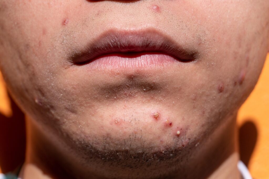 Understanding the Root Causes of Acne acne, shin, dermatology, skin, puberty, teen, young, treatment, medicine, sickness, remedy, health, cosmetics, acne, acne, acne, acne, acne